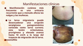Manifestaciones clínicas
● Manifestación cutánea más
frecuente: es una urticaria
recurrente que a menudo afecta las
nalgas y las muñecas.
● La larva migratoria puede
desencadenar una erupción
serpiginosa patognomónica
conocida como larva currens;
esta lesión eritematosa,
pruriginosa y elevada avanza
hasta 10 cm/h a lo largo del
trayecto de migración de la larva.
●eosinofilia
 