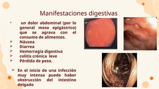 Manifestaciones digestivas
 un dolor abdominal (por lo
general meso epigástrico)
que se agrava con el
consumo de alimentos.
 Náusea
 Diarrea
 Hemorragia digestiva
 colitis crónica leve
 Pérdida de peso.
 En el inicio de una infección
muy intensa puede haber
obstrucción del intestino
delgado
 