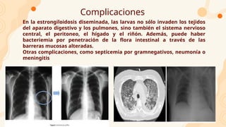 Complicaciones
En la estrongiloidosis diseminada, las larvas no sólo invaden los tejidos
del aparato digestivo y los pulmones, sino también el sistema nervioso
central, el peritoneo, el hígado y el riñón. Además, puede haber
bacteriemia por penetración de la flora intestinal a través de las
barreras mucosas alteradas.
Otras complicaciones, como septicemia por gramnegativos, neumonía o
meningitis
 