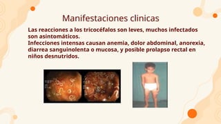 Manifestaciones clinicas
Las reacciones a los tricocéfalos son leves, muchos infectados
son asintomáticos.
Infecciones intensas causan anemia, dolor abdominal, anorexia,
diarrea sanguinolenta o mucosa, y posible prolapso rectal en
niños desnutridos.
 