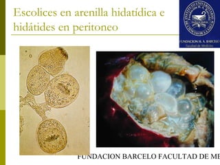 FUNDACION BARCELO FACULTAD DE ME
Escolices en arenilla hidatídica e
hidátides en peritoneo
 