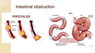 Intestinal obstruction
 