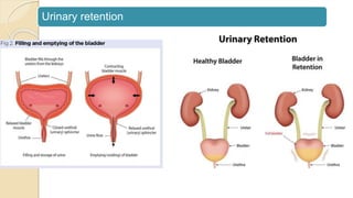 Urinary retention
 