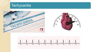 Tachycardia
 