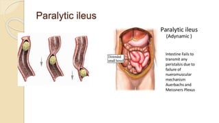 Paralytic ileus
 