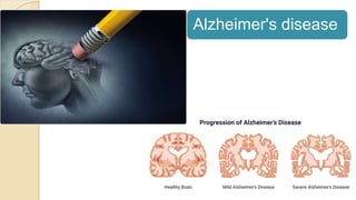 Alzheimer's disease
 