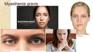 Myasthenia gravis
 