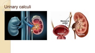 Urinary calculi
 