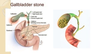 Gallbladder stone
 