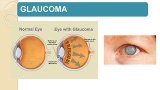 GLAUCOMA
 