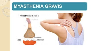 MYASTHENIA GRAVIS
 
