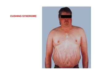 CUSHING SYNDROME
 