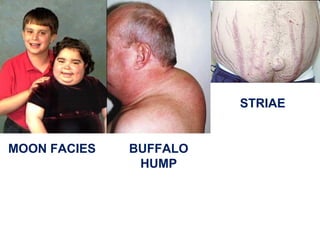 MOON FACIES BUFFALO
HUMP
STRIAE
 