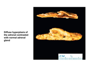 Diffuse hyperplasia of
the adrenal contrasted
with normal adrenal
gland
 