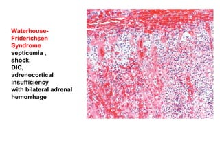 Waterhouse-
Friderichsen
Syndrome
septicemia ,
shock,
DIC,
adrenocortical
insufficiency
with bilateral adrenal
hemorrhage
 