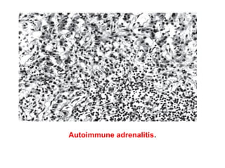 Autoimmune adrenalitis.
 