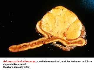 Adrenocortical adenomas; a well-circumscribed, nodular lesion up to 2.5 cm
expands the adrenal.
Most are clinically silent
 