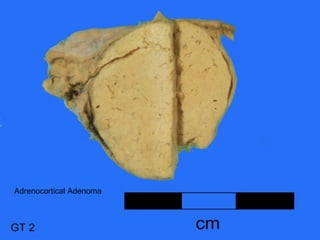 Adrenocortical Adenoma
 