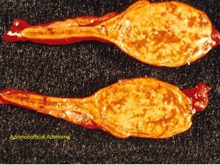 Adrenocortical Adenoma
 