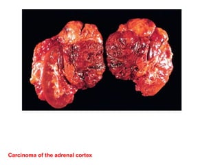 Carcinoma of the adrenal cortex
 