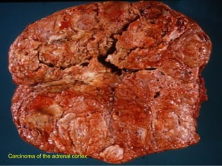Carcinoma of the adrenal cortex
 