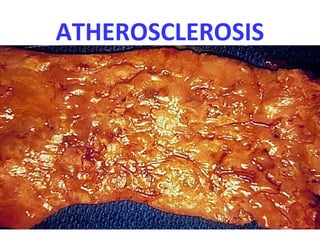 ATHEROSCLEROSIS
 