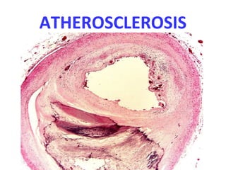 ATHEROSCLEROSIS
 