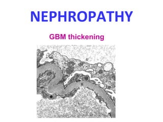NEPHROPATHY
GBM thickening
 