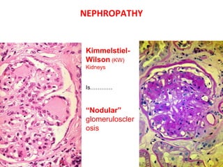 NEPHROPATHY
Kimmelstiel-
Wilson (KW)
Kidneys
Is…………
“Nodular”
glomeruloscler
osis
 