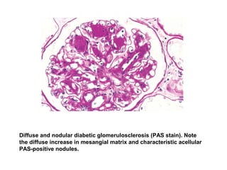 Diffuse and nodular diabetic glomerulosclerosis (PAS stain). Note
the diffuse increase in mesangial matrix and characteristic acellular
PAS-positive nodules.
 