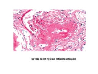 Severe renal hyaline arteriolosclerosis
 