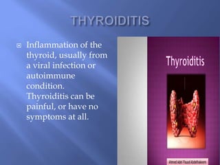  Inflammation of the
thyroid, usually from
a viral infection or
autoimmune
condition.
Thyroiditis can be
painful, or have no
symptoms at all.
 
