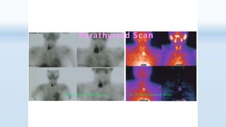 Parathyroid Scan
Dual phase MIBI Scan Tc-Tl Subtraction Scan
 