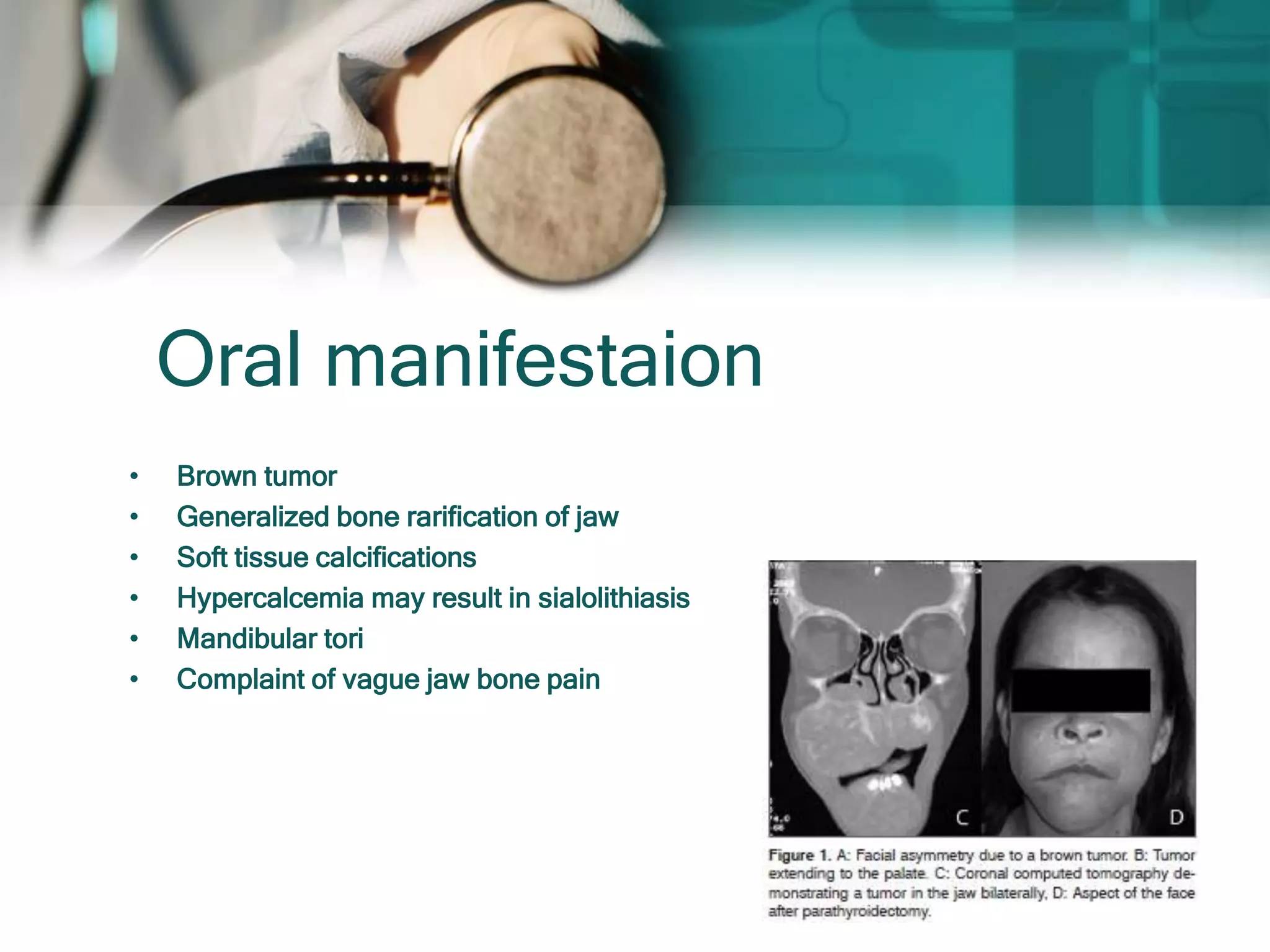 Oral manifestaion
• Brown tumor
• Generalized bone rarification of jaw
• Soft tissue calcifications
• Hypercalcemia may result in sialolithiasis
• Mandibular tori
• Complaint of vague jaw bone pain
 