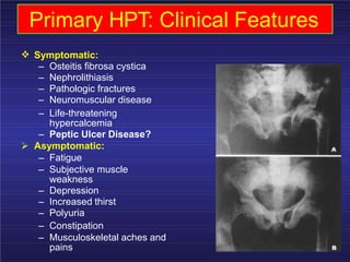 Primary HPT: Clinical Features
Symptomatic:
– Osteitis fibrosa cystica
– Nephrolithiasis
– Pathologic fractures
– Neuromuscular disease
– Life-threatening
hypercalcemia
– Peptic Ulcer Disease?
Asymptomatic:
– Fatigue
– Subjective muscle
weakness
– Depression
– Increased thirst
– Polyuria
– Constipation
– Musculoskeletal aches and
pains
 