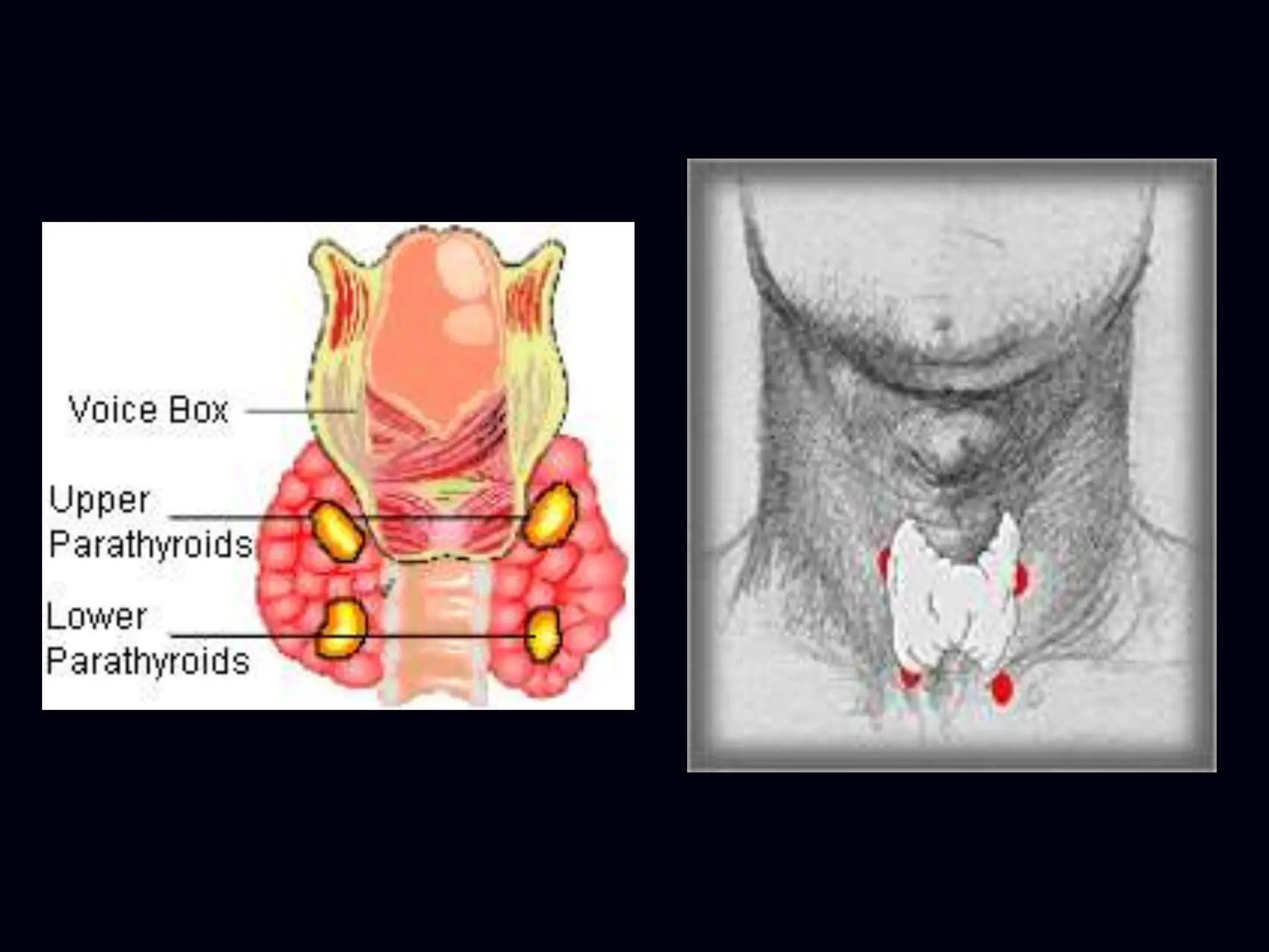 Parathyroid Eye PARATHYROID GLANDS and diseases ppt .ppt