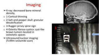 Imaging
➢X-ray: decreased bone mineral
density,
o 1-Cortical thinning
o 2-Salt-and-pepper skull: granular
decalcification
o 3-Rugger-jersey spine sign
o 4-Osteitis fibrosa cystica: cyst-like
brown tumors located in
osteolytic spaces
➢Ultrasound/nuclear imaging
(Tc99m-sestamibi scan)
3 4
 