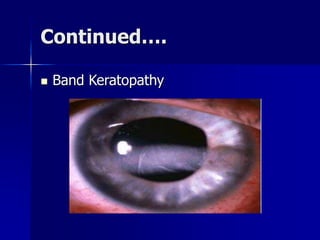 Continued….
 Band Keratopathy
 