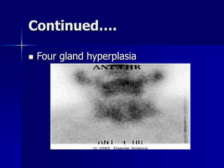 Continued….
 Four gland hyperplasia
 