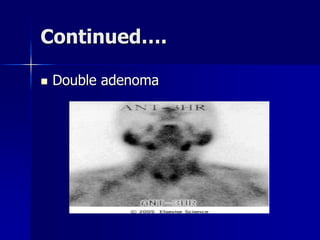 Continued….
 Double adenoma
 