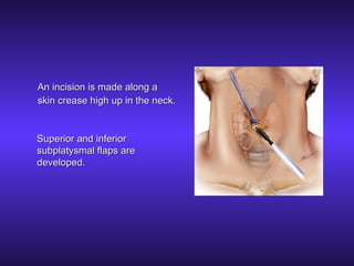 Parathyroid Incision Parathyroid Surgery | PPT