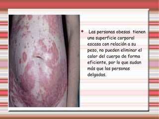  Las personas obesas tienen 
una superficie corporal 
escasa con relación a su 
peso, no pueden eliminar el 
calor del cuerpo de forma 
eficiente, por lo que sudan 
más que las personas 
delgadas. 
 