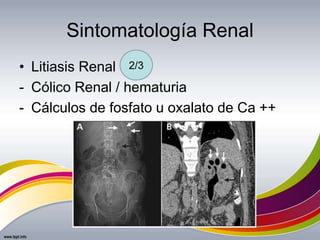 Sintomatología Renal
• Litiasis Renal
- Cólico Renal / hematuria
- Cálculos de fosfato u oxalato de Ca ++
2/3
 