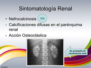 Sintomatología Renal
• Nefrocalcinosis
- Calcificaciones difusas en el parénquima
renal
- Acción Osteoclástica
10%
Se acompaña de
insuficiencia renal
 