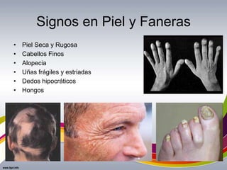 Signos en Piel y Faneras
• Piel Seca y Rugosa
• Cabellos Finos
• Alopecia
• Uñas frágiles y estriadas
• Dedos hipocráticos
• Hongos
 