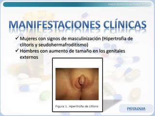 PARATIROIDES Y SUPRARRENALES
 Mujeres con signos de masculinización (Hipertrofia de
clítoris y seudohermafroditismo)
 Hombres con aumento de tamaño en los genitales
externos
 