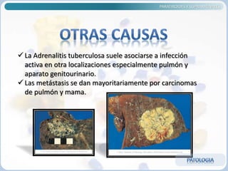 PARATIROIDES Y SUPRARRENALES
 La Adrenalitis tuberculosa suele asociarse a infección
activa en otra localizaciones especialmente pulmón y
aparato genitourinario.
 Las metástasis se dan mayoritariamente por carcinomas
de pulmón y mama.
 