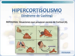 PATOGENIA: Situaciones que provocan exceso de Cortisol (4).
PARATIROIDES Y SUPRARRENALES
 