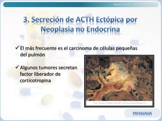  El más frecuente es el carcinoma de células pequeñas
del pulmón
 Algunos tumores secretan
factor liberador de
corticotropina
PARATIROIDES Y SUPRARRENALES
 