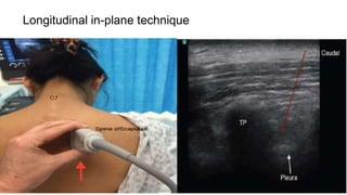 Longitudinal in-plane technique
 